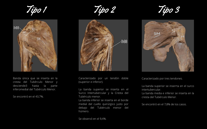 Tendon Subescapular Ecografia Ultrasound.png